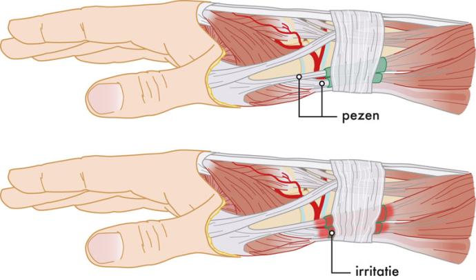 Operatie bij een peesirritatie van duim en pols (De Quervain) | Jeroen